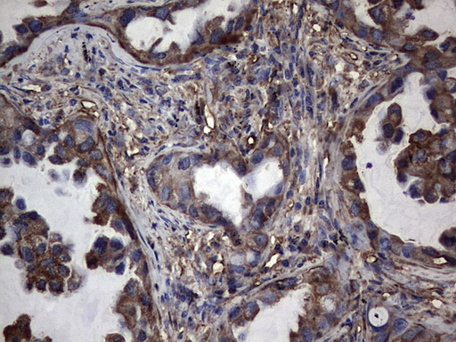 PKM2 Antibody - IHC of paraffin-embedded Carcinoma of Human lung tissue using anti-PKM2 Mouse monoclonal antibody.