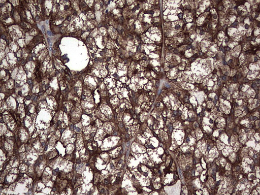 PKM2 Antibody - IHC of paraffin-embedded Carcinoma of Human thyroid tissue using anti-PKM2 Mouse monoclonal antibody.