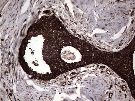 PKM2 Antibody - IHC of paraffin-embedded Carcinoma of Human prostate tissue using anti-PKM2 Mouse monoclonal antibody.