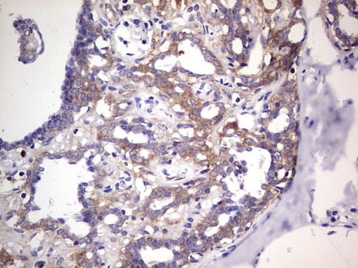 PKM2 Antibody - IHC of paraffin-embedded Adenocarcinoma of Human breast tissue using anti-PKM2 mouse monoclonal antibody.
