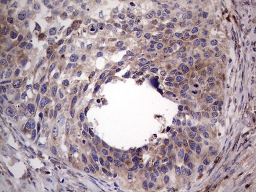 PKM2 Antibody - IHC of paraffin-embedded Carcinoma of Human kidney tissue using anti-PKM2 mouse monoclonal antibody.