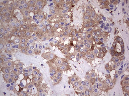 PKM2 Antibody - IHC of paraffin-embedded Carcinoma of Human liver tissue using anti-PKM2 mouse monoclonal antibody.