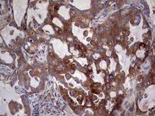 PKM2 Antibody - IHC of paraffin-embedded Carcinoma of Human lung tissue using anti-PKM2 mouse monoclonal antibody.