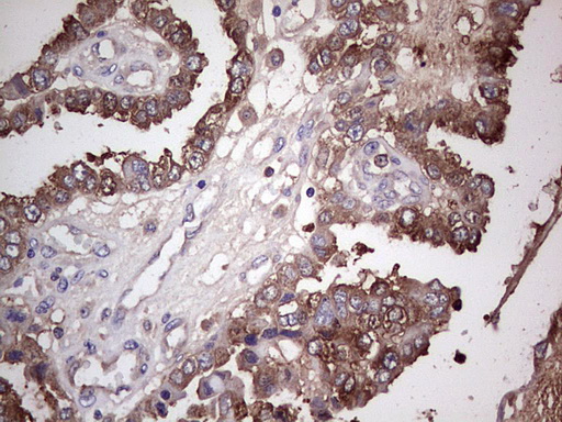 PKM2 Antibody - IHC of paraffin-embedded Adenocarcinoma of Human ovary tissue using anti-PKM2 mouse monoclonal antibody.