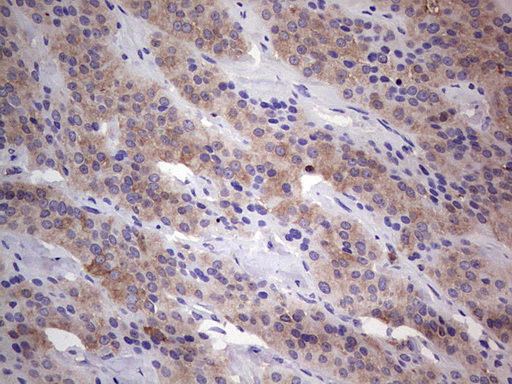 PKM2 Antibody - IHC of paraffin-embedded Carcinoma of Human thyroid tissue using anti-PKM2 mouse monoclonal antibody.