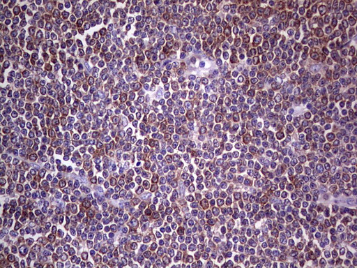 PKM2 Antibody - IHC of paraffin-embedded Human lymphoma tissue using anti-PKM2 mouse monoclonal antibody.