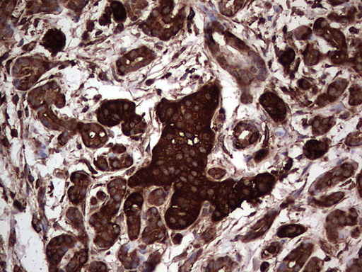 PKM2 Antibody - IHC of paraffin-embedded Carcinoma of Human pancreas tissue using anti-PKM2 mouse monoclonal antibody.