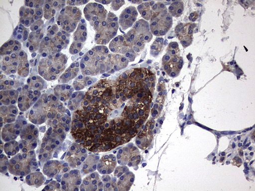 PKM2 Antibody - IHC of paraffin-embedded Carcinoma of Human pancreas tissue using anti-PKM2 mouse monoclonal antibody.