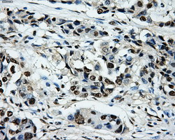 PKMYT1 Antibody - IHC of paraffin-embedded Adenocarcinoma of breast tissue using anti-PKMYT1 mouse monoclonal antibody. (Dilution 1:50).
