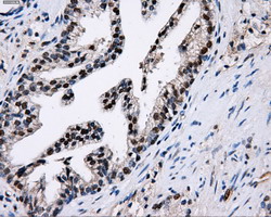 PKMYT1 Antibody - IHC of paraffin-embedded Carcinoma of prostate tissue using anti-PKMYT1 mouse monoclonal antibody. (Dilution 1:50).