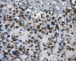 PKMYT1 Antibody - IHC of paraffin-embedded Carcinoma of bladder tissue using anti-PKMYT1 mouse monoclonal antibody. (Dilution 1:50).