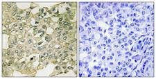 PKMYT1 Antibody - Immunohistochemistry analysis of paraffin-embedded human breast carcinoma, using MYT1 (Phospho-Ser83) Antibody. The picture on the right is blocked with the phospho peptide.