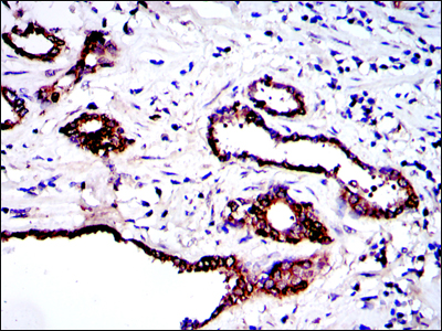 PKN2 Antibody - IHC of paraffin-embedded prostate tissues using PRK2 mouse monoclonal antibody with DAB staining.