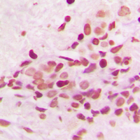 PKNOX2 Antibody - Immunohistochemical analysis of PKNOX2 staining in human breast cancer formalin fixed paraffin embedded tissue section. The section was pre-treated using heat mediated antigen retrieval with sodium citrate buffer (pH 6.0). The section was then incubated with the antibody at room temperature and detected using an HRP conjugated compact polymer system. DAB was used as the chromogen. The section was then counterstained with hematoxylin and mounted with DPX.
