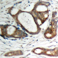 PKP2 / Plakophilin 2 Antibody - Immunohistochemical analysis of Plakophilin 2 staining in human prostate cancer formalin fixed paraffin embedded tissue section. The section was pre-treated using heat mediated antigen retrieval with sodium citrate buffer (pH 6.0). The section was then incubated with the antibody at room temperature and detected using an HRP polymer system. DAB was used as the chromogen. The section was then counterstained with hematoxylin and mounted with DPX.