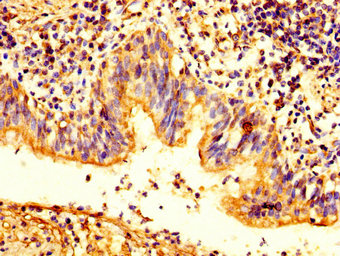 PKP2 / Plakophilin 2 Antibody - Immunohistochemistry image at a dilution of 1:200 and staining in paraffin-embedded human lung cancer performed on a Leica BondTM system. After dewaxing and hydration, antigen retrieval was mediated by high pressure in a citrate buffer (pH 6.0) . Section was blocked with 10% normal goat serum 30min at RT. Then primary antibody (1% BSA) was incubated at 4 °C overnight. The primary is detected by a biotinylated secondary antibody and visualized using an HRP conjugated SP system.