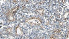 PKP4 / Plakophilin 4 Antibody - 1:100 staining human prostate tissue by IHC-P. The sample was formaldehyde fixed and a heat mediated antigen retrieval step in citrate buffer was performed. The sample was then blocked and incubated with the antibody for 1.5 hours at 22°C. An HRP conjugated goat anti-rabbit antibody was used as the secondary.