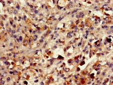 PLA2G10 Antibody - Immunohistochemistry of paraffin-embedded human melanoma cancer using PLA2G10 Antibody at dilution of 1:100