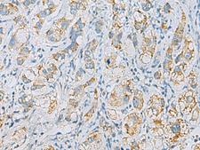 PLA2G15 / ACS Antibody - Immunohistochemistry of paraffin-embedded Human liver cancer tissue  using PLA2G15 Polyclonal Antibody at dilution of 1:65(×200)