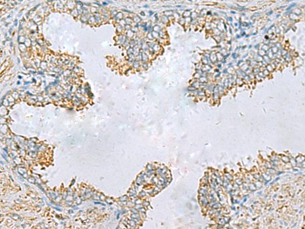 PLA2G15 / ACS Antibody - Immunohistochemistry of paraffin-embedded Human prost ate cancer tissue  using PLA2G15 Polyclonal Antibody at dilution of 1:65(×200)