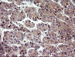 PLA2G16 / HRASLS3 Antibody - IHC of paraffin-embedded Carcinoma of Human liver tissue using anti-PLA2G16 mouse monoclonal antibody. (Heat-induced epitope retrieval by 10mM citric buffer, pH6.0, 120°C for 3min).