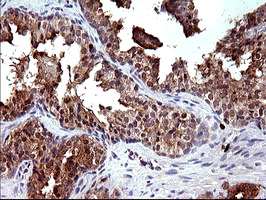 PLA2G16 / HRASLS3 Antibody - IHC of paraffin-embedded Carcinoma of Human prostate tissue using anti-PLA2G16 mouse monoclonal antibody. (Heat-induced epitope retrieval by 10mM citric buffer, pH6.0, 120°C for 3min).