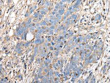 PLA2G16 / HRASLS3 Antibody - Immunohistochemistry of paraffin-embedded Human thyroid cancer tissue  using PLA2G16 Polyclonal Antibody at dilution of 1:40(×200)