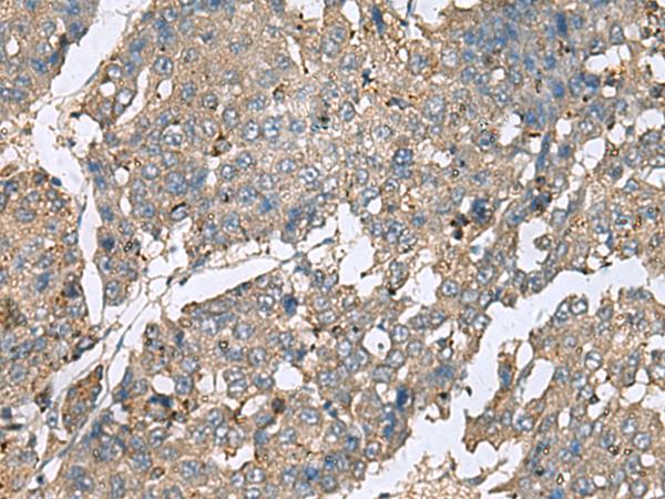 PLA2G2A / SPLA2 Antibody - Immunohistochemistry of paraffin-embedded Human liver cancer tissue  using PLA2G2A Polyclonal Antibody at dilution of 1:50(×200)