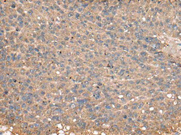 PLA2G2A / SPLA2 Antibody - Immunohistochemistry of paraffin-embedded Human liver cancer tissue  using PLA2G2A Polyclonal Antibody at dilution of 1:55(×200)