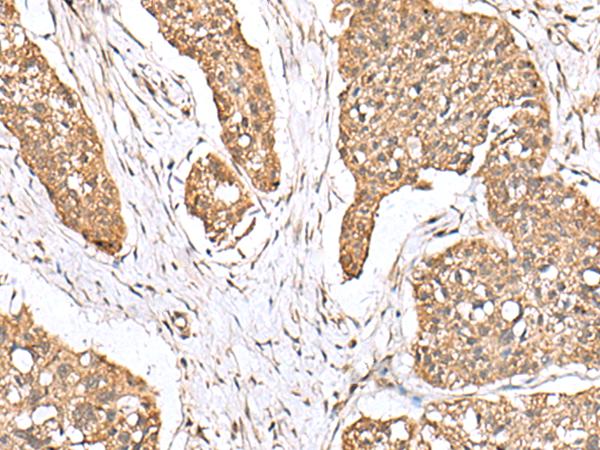 PLA2G2A / SPLA2 Antibody - Immunohistochemistry of paraffin-embedded Human esophagus cancer tissue  using PLA2G2A Polyclonal Antibody at dilution of 1:55(×200)