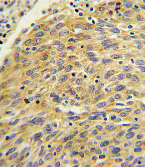 PLA2G4A Antibody - Formalin-fixed and paraffin-embedded human lung carcinoma with PLA2G4A Antibody , which was peroxidase-conjugated to the secondary antibody, followed by DAB staining. This data demonstrates the use of this antibody for immunohistochemistry; clinical relevance has not been evaluated.