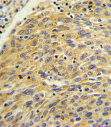 PLA2G4A Antibody - Formalin-fixed and paraffin-embedded human lung carcinoma with PLA2G4A Antibody , which was peroxidase-conjugated to the secondary antibody, followed by DAB staining. This data demonstrates the use of this antibody for immunohistochemistry; clinical relevance has not been evaluated.