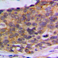 PLA2G4A Antibody - Immunohistochemical analysis of PLA2G4A staining in human breast cancer formalin fixed paraffin embedded tissue section. The section was pre-treated using heat mediated antigen retrieval with sodium citrate buffer (pH 6.0). The section was then incubated with the antibody at room temperature and detected using an HRP conjugated compact polymer system. DAB was used as the chromogen. The section was then counterstained with hematoxylin and mounted with DPX.