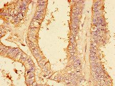 PLA2G4A Antibody - Immunohistochemistry of paraffin-embedded human endometrial cancer tissue using PLA2G4A Antibody at dilution of 1:100