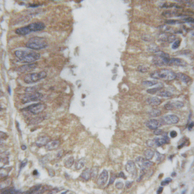 PLA2G4A Antibody - 1/100 staining human colon  tissue by IHC-P. The sample was formaldehyde fixed and a heat mediated antigen retrieval step in citrate buffer was performed. The sample was then blocked and incubated with the antibody for 1.5 hours at 22°C. An HRP conjugated goat anti-rabbit antibody was used as the secondary antibody.