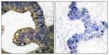 PLA2G4A Antibody - Peptide - + Immunohistochemistry analysis of paraffin-embedded human colon carcinoma tissue using c-PLA2 (Ab-505) antibody.