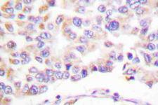 PLA2G4A Antibody - Immunohistochemistry (IHC) analysis of p-cPLA2 (S505) pAb in paraffin-embedded human breast cancer tissue.