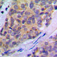 PLA2G4A Antibody - Immunohistochemical analysis of PLA2G4A (pS505) staining in human breast cancer formalin fixed paraffin embedded tissue section. The section was pre-treated using heat mediated antigen retrieval with sodium citrate buffer (pH 6.0). The section was then incubated with the antibody at room temperature and detected using an HRP conjugated compact polymer system. DAB was used as the chromogen. The section was then counterstained with hematoxylin and mounted with DPX.