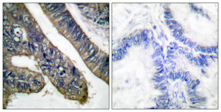 PLA2G4A Antibody - P-peptide - + Immunohistochemical analysis of paraffin-embedded human colon carcinoma tissue using c-PLA2 (Phospho-Ser505) antibody.