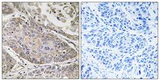 PLA2G4E Antibody - Immunohistochemistry analysis of paraffin-embedded human lung carcinoma, using PLA2G4E Antibody. The picture on the right is blocked with the synthesized peptide.