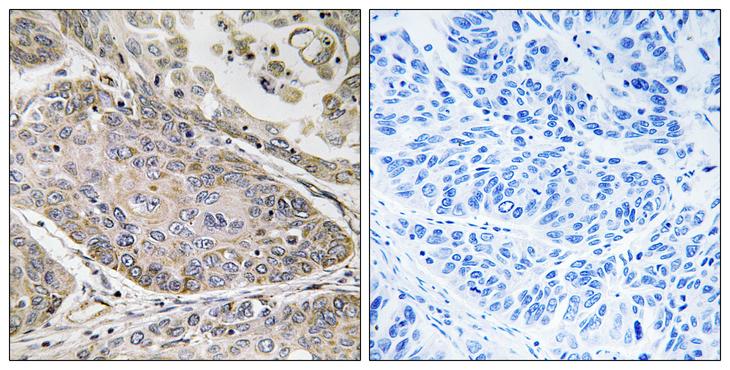 PLA2G4E Antibody - Peptide - + Immunohistochemistry analysis of paraffin-embedded human lung carcinoma tissue using PLA2G4E antibody.