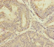 PLAA Antibody - Immunohistochemistry of paraffin-embedded human endometrial cancer at dilution of 1:100