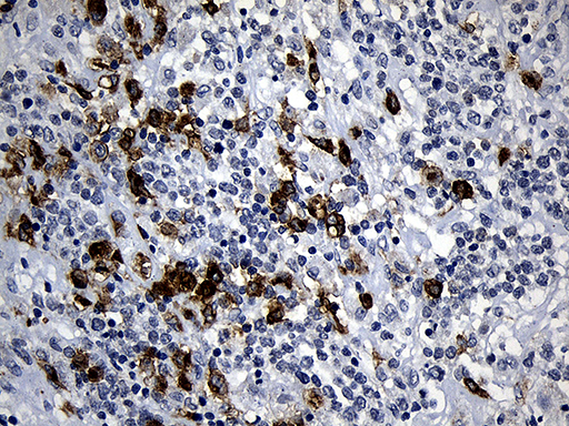 PLAC8 Antibody - Immunohistochemical staining of paraffin-embedded Human lymphoma tissue using anti-PLAC8 mouse monoclonal antibody. (Heat-induced epitope retrieval by 1mM EDTA in 10mM Tris buffer. (pH8.5) at 120°C for 3 min. (1:500)