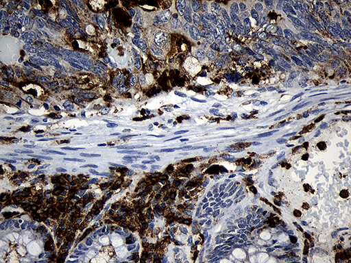 PLAC8 Antibody - Immunohistochemical staining of paraffin-embedded Adenocarcinoma of Human colon tissue using anti-PLAC8 mouse monoclonal antibody. (Heat-induced epitope retrieval by 1mM EDTA in 10mM Tris buffer. (pH8.5) at 120°C for 3 min. (1:500)