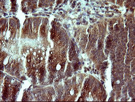 Placental Lactogen Antibody - IHC of paraffin-embedded Carcinoma of Human pancreas tissue using anti-CSH1 mouse monoclonal antibody. (Heat-induced epitope retrieval by 10mM citric buffer, pH6.0, 120°C for 3min).