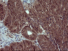 Placental Lactogen Antibody - IHC of paraffin-embedded Adenocarcinoma of Human ovary tissue using anti-CSH1 mouse monoclonal antibody. (Heat-induced epitope retrieval by 10mM citric buffer, pH6.0, 120°C for 3min).