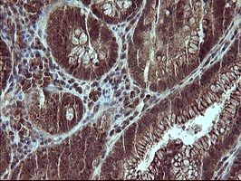 Placental Lactogen Antibody - IHC of paraffin-embedded Adenocarcinoma of Human colon tissue using anti-CSH1 mouse monoclonal antibody. (Heat-induced epitope retrieval by 10mM citric buffer, pH6.0, 120°C for 3min).