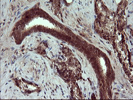 Placental Lactogen Antibody - IHC of paraffin-embedded Carcinoma of Human prostate tissue using anti-CSH1 mouse monoclonal antibody. (Heat-induced epitope retrieval by 10mM citric buffer, pH6.0, 120°C for 3min).