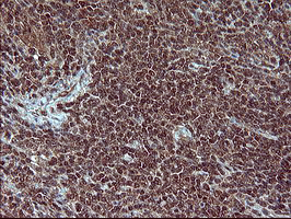 Placental Lactogen Antibody - IHC of paraffin-embedded Human lymphoma tissue using anti-CSH1 mouse monoclonal antibody. (Heat-induced epitope retrieval by 10mM citric buffer, pH6.0, 120°C for 3min).