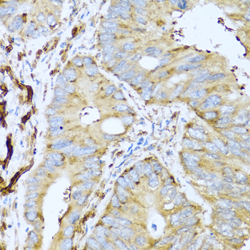 Placental Lactogen Antibody - Immunohistochemistry of paraffin-embedded human colon carcinoma tissue.